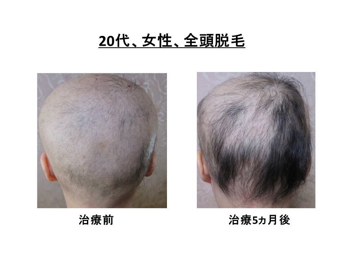 円形脱毛症　病院""